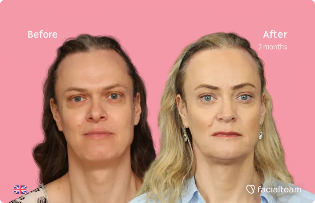 Frontal image of FFS patient Elle showing the results before and after facial feminization surgery with Facialteam consisting of rhinoplasty, jaw and chin, forehead feminization surgery.