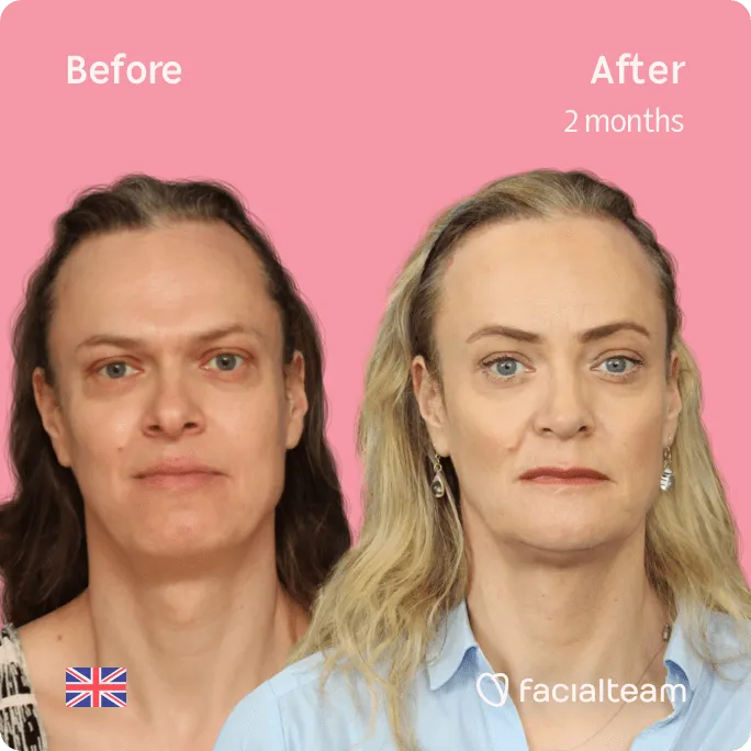 Square frontal image of FFS patient Elle showing the results before and after facial feminization surgery with Facialteam consisting of rhinoplasty, jaw and chin, forehead feminization surgery.