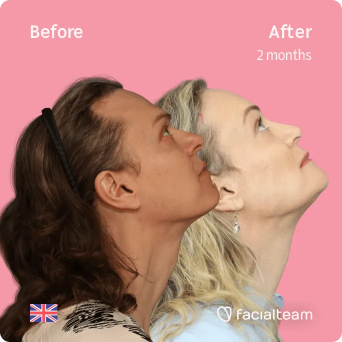 Square Side up image of FFS patient Elle showing the results before and after facial feminization surgery with Facialteam consisting of rhinoplasty, jaw and chin, forehead feminization surgery.