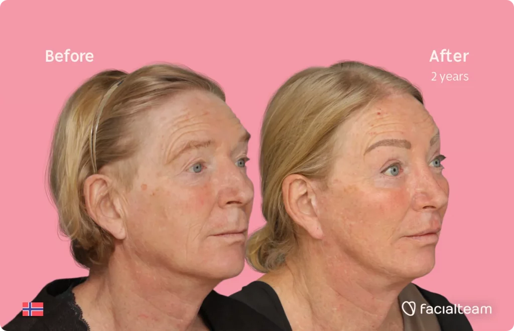 45 degree image of FFS patient Frida showing the results before and after facial feminization surgery consisting of rhinoplasty, tracheal shave, forehead, jaw and chin, lip feminization surgery.