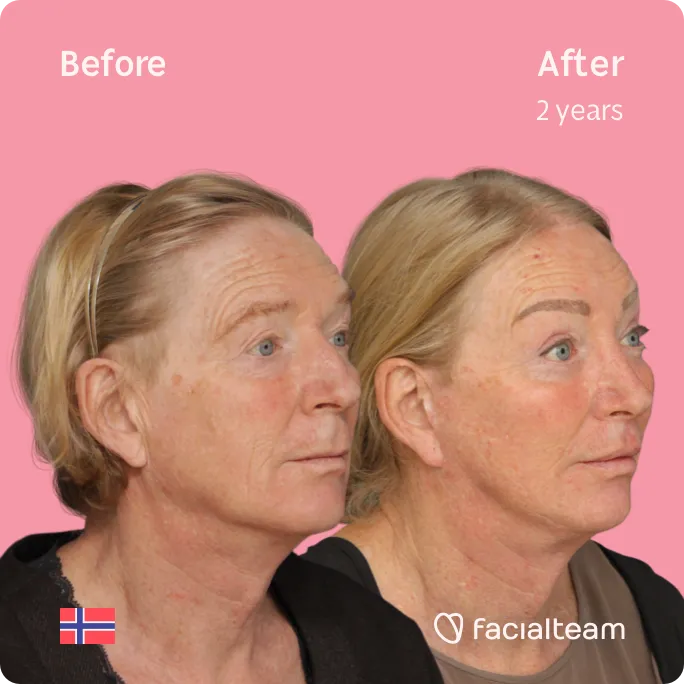 Square 45 degree image of FFS patient Frida showing the results before and after facial feminization surgery consisting of rhinoplasty, tracheal shave, forehead, jaw and chin, lip feminization surgery.