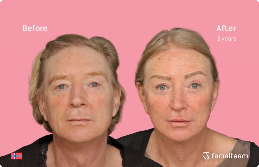 Frontal image of FFS patient Frida showing the results before and after facial feminization surgery with Facialteam consisting of rhinoplasty, tracheal shave, forehead, jaw and chin, lip feminization surgery.