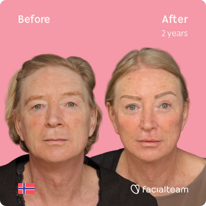 Square frontal image of FFS patient Frida showing the results before and after facial feminization surgery with Facialteam consisting of rhinoplasty, tracheal shave, forehead, jaw and chin, lip feminization surgery.