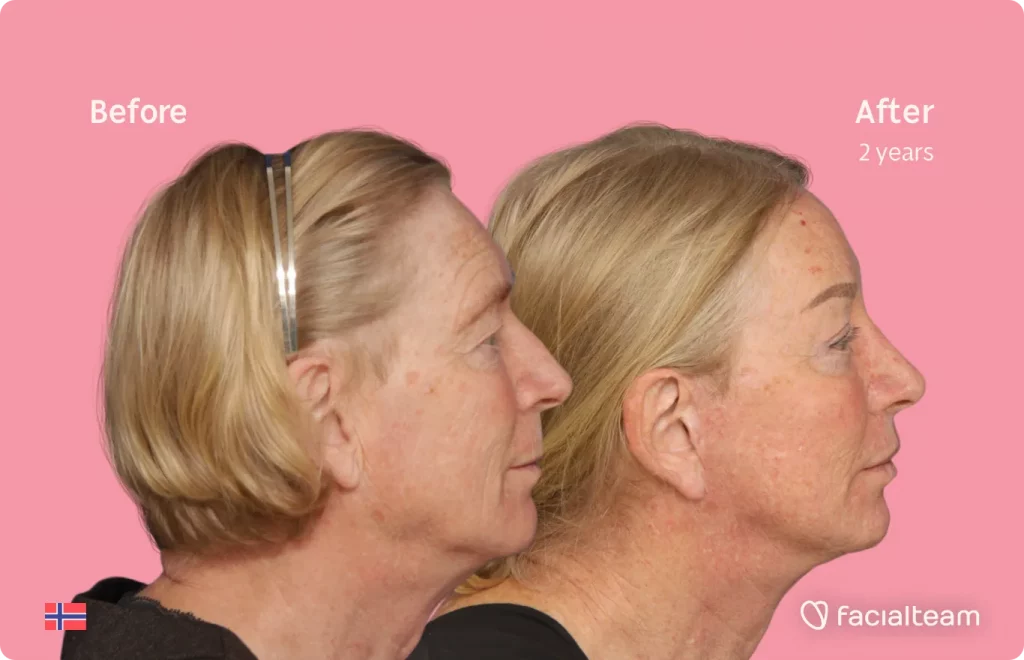 Side image of FFS patient Frida showing the results before and after facial feminization surgery with Facialteam consisting of rhinoplasty, tracheal shave, forehead, jaw and chin, lip feminization surgery.