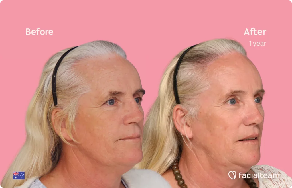 45 degree image of FFS patient Sarah C showing the results before and after facial feminization surgery consisting of rhinoplasty, tracheal shave, forehead, jaw and chin, lip feminization surgery.