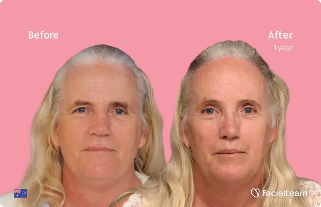 Frontal image of FFS patient Sarah C showing the results before and after facial feminization surgery with Facialteam consisting of rhinoplasty, tracheal shave, forehead, jaw and chin, lip feminization surgery.