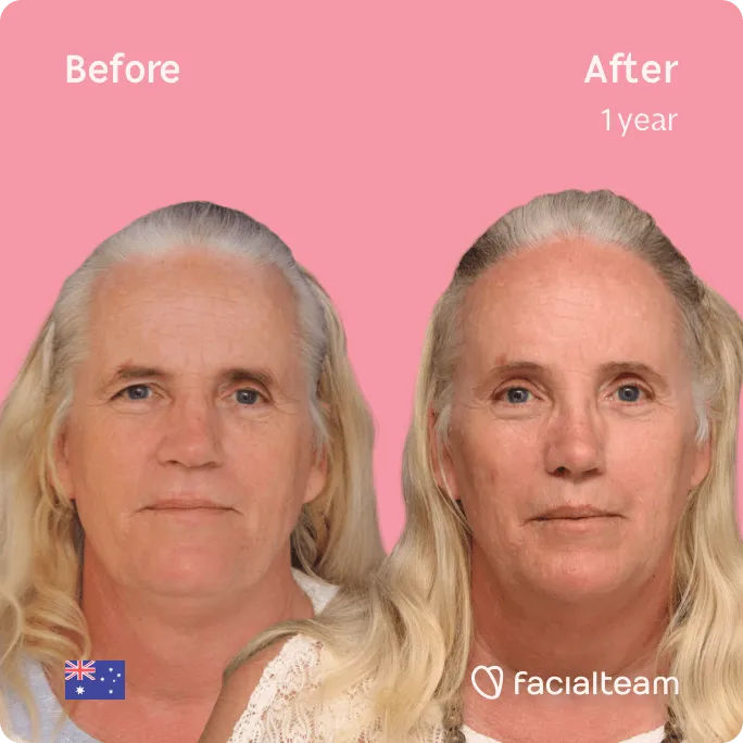 Square frontal image of FFS patient Sarah C showing the results before and after facial feminization surgery with Facialteam consisting of rhinoplasty, tracheal shave, forehead, jaw and chin, lip feminization surgery.