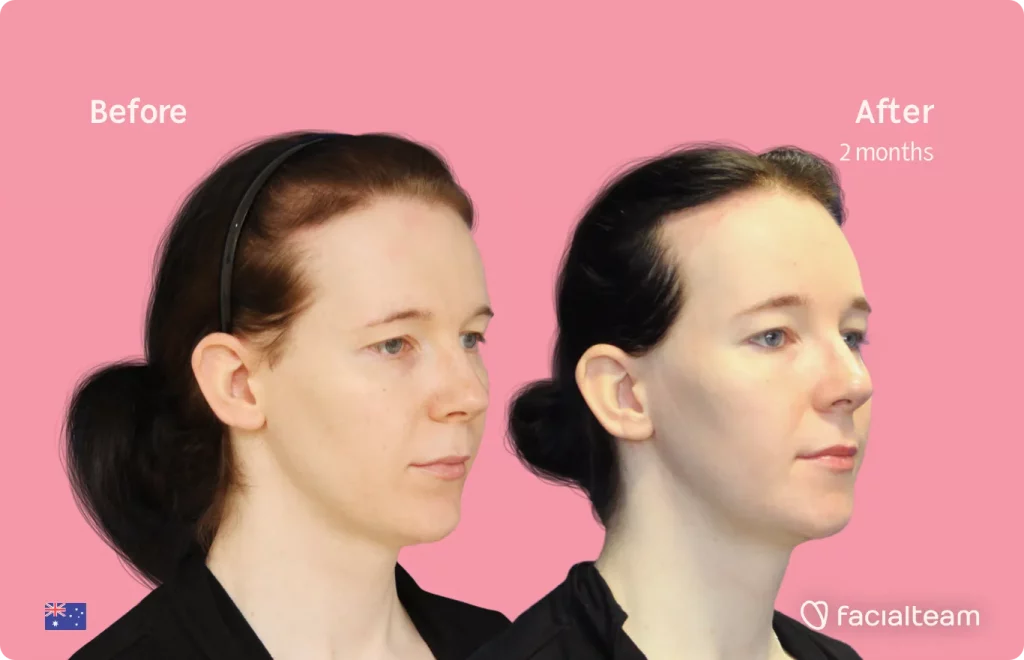 45 degree image of FFS patient Ashleigh showing the results before and after facial feminization surgery consisting of tracheal shave, forehead, jaw and chin feminization surgery.