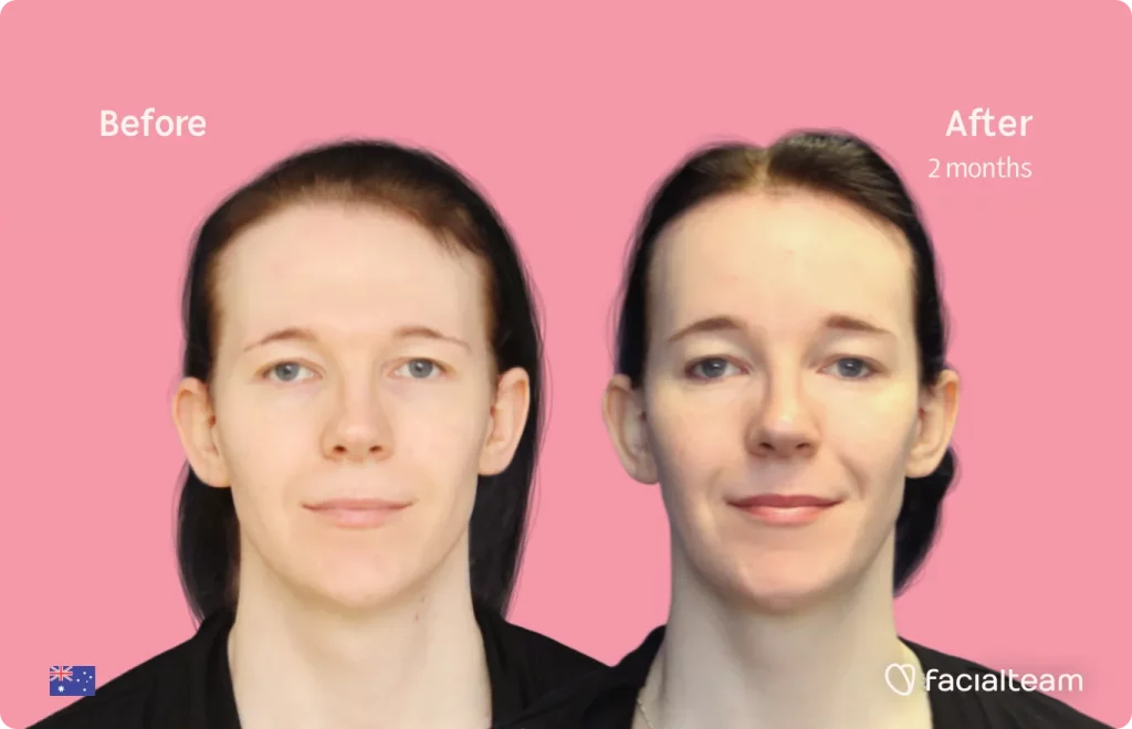 Frontal image of FFS patient Ashleigh showing the results before and after facial feminization surgery with Facialteam consisting of tracheal shave, forehead, jaw and chin feminization surgery.