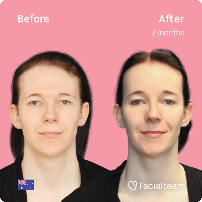 Square frontal image of FFS patient Ashleigh showing the results before and after facial feminization surgery with Facialteam consisting of tracheal shave, forehead, jaw and chin feminization surgery.