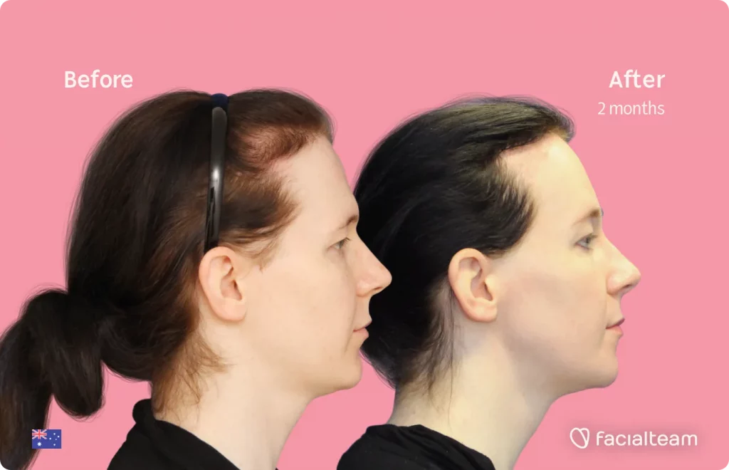 Side image of FFS patient Ashleigh showing the results before and after facial feminization surgery with Facialteam consisting of tracheal shave, forehead, jaw and chin feminization surgery.