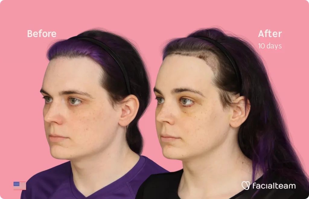 45 degree image of FFS patient Téa showing the results before and after facial feminization surgery consisting of tracheal shave, forehead, jaw and chin feminization surgery.