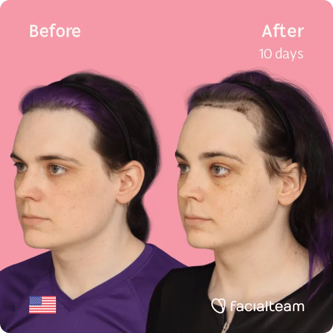 Square 45 degree image of FFS patient Téa showing the results before and after facial feminization surgery consisting of tracheal shave, forehead, jaw and chin feminization surgery.
