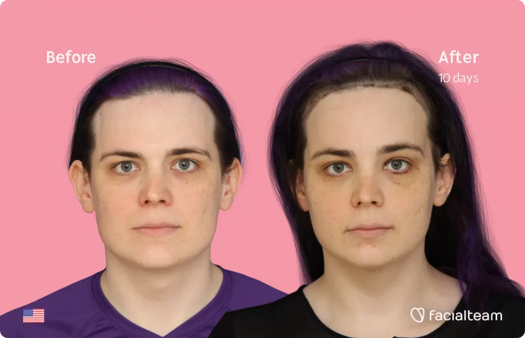Frontal image of FFS patient Téa showing the results before and after facial feminization surgery with Facialteam consisting of tracheal shave, forehead, jaw and chin feminization surgery.