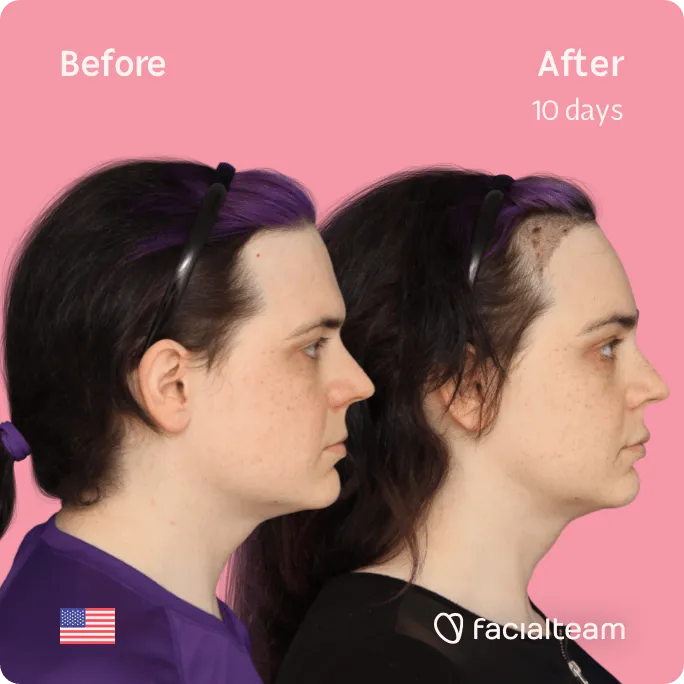 Square Side image of FFS patient Téa showing the results before and after facial feminization surgery with Facialteam consisting of tracheal shave, forehead, jaw and chin feminization surgery.