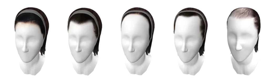 Different types of hairlines to help determine which hairtype a patient has and which is the best approach for hairline feminization surgery