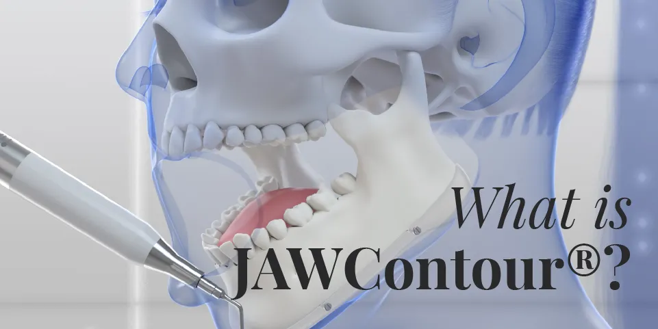 Still from an illustrated 3d video explaining in 3D how jaw feminization surgery is performed using JAWContour, a revolutionary method using the latest technologies to perform this type of surgery.