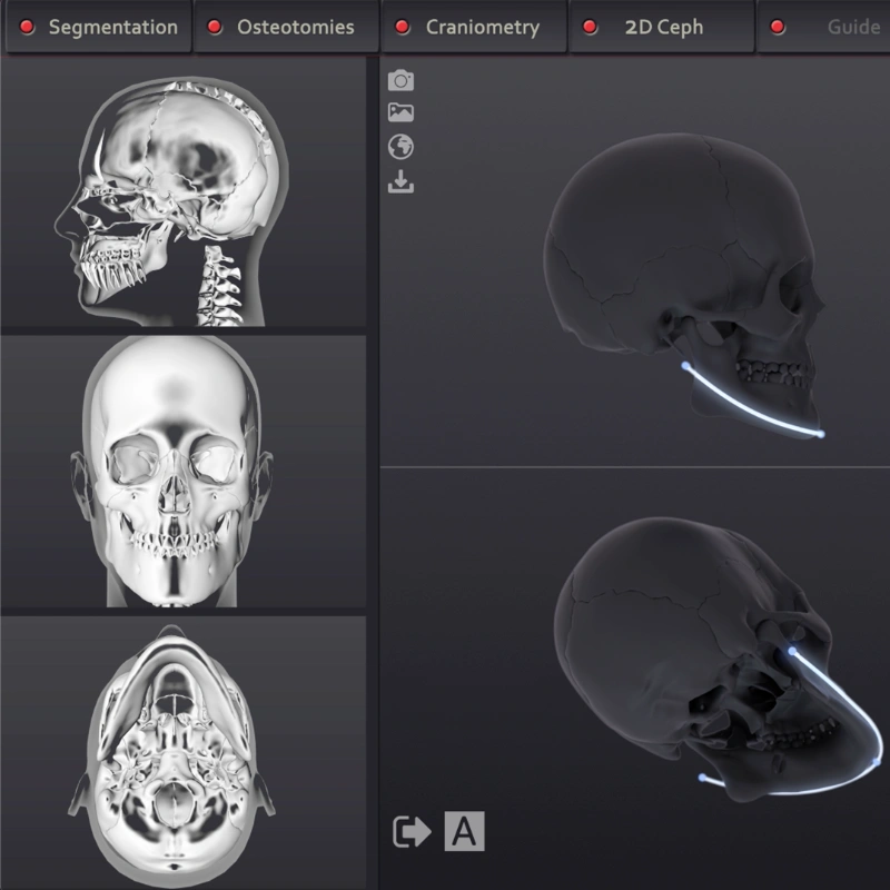 Still of a 3D animation on jaw transgender surgery. The animation shows how we use 3D software to design the cuts and cutting guide prior to mtf jaw surgery.