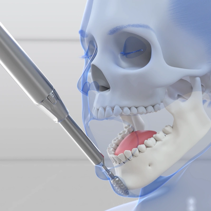 Still of a 3D animation on jaw transgender surgery. The animation shows how jaw line and chin are burred after the mandibula has been contoured.