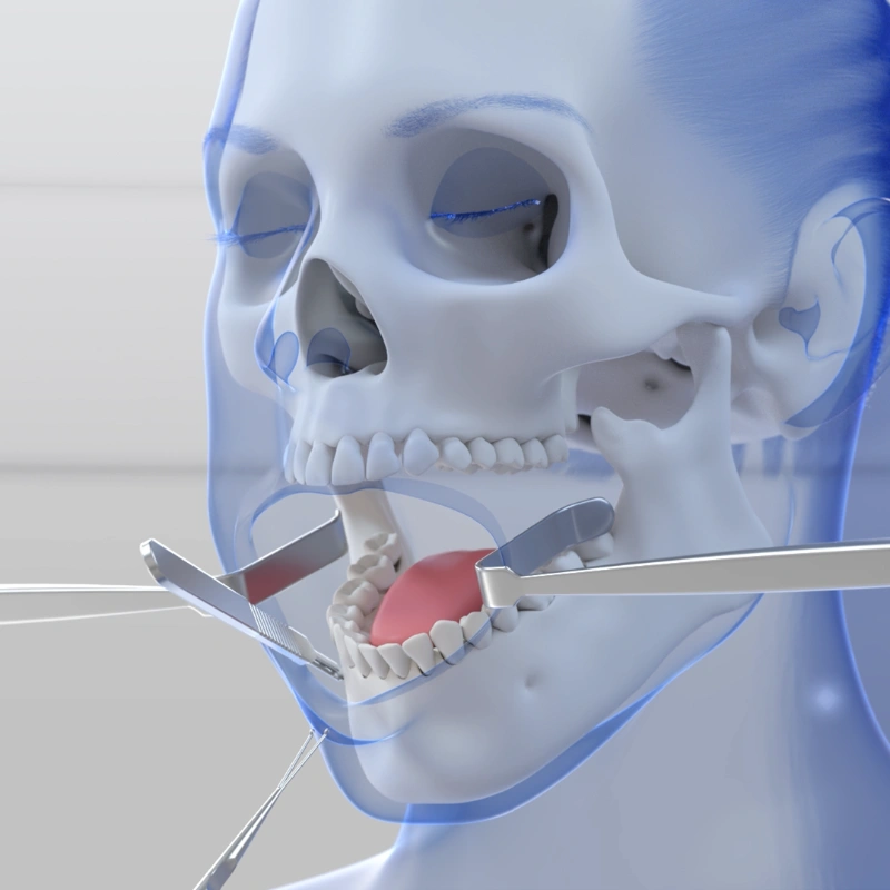Still of a 3D animation on jaw transgender surgery. The animation shows how the incisions are placed inside the mouth to avoid scars during mtf jaw surgery.