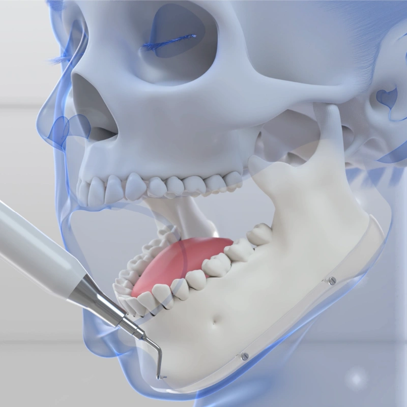 Still of a 3D animation on jaw transgender surgery. The animation shows the cutting of the mandibular bone during mtf jaw surgery.