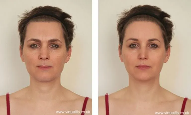 Example of a virtual ffs simulation by Alexandra Hammer from virtualffs.co.uk of a facial feminization surgery patient. Alexandra did extensive research on what makes a good ffs surgeon.