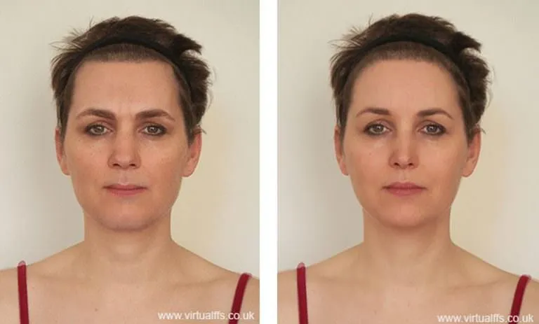 Example of a virtual ffs simulation of a facial feminization surgery patient