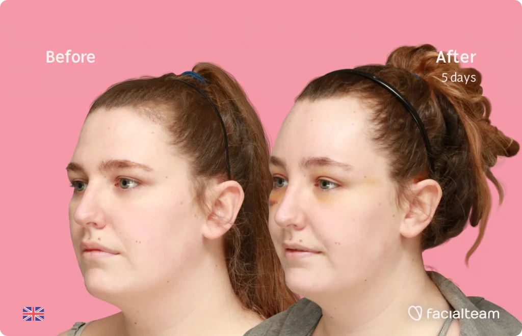 45 degree image of FFS patient Alexis showing the results before and after facial feminization surgery consisting of forehead feminization surgery.