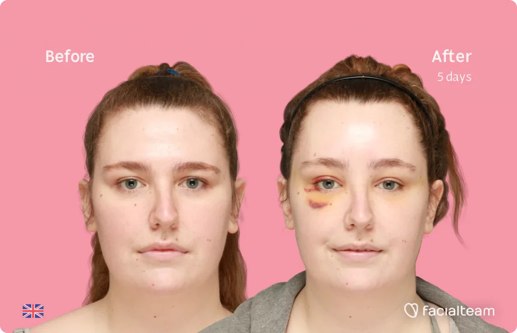 Frontal image of FFS patient Alexis showing the results before and after facial feminization surgery with Facialteam consisting of forehead feminization surgery.