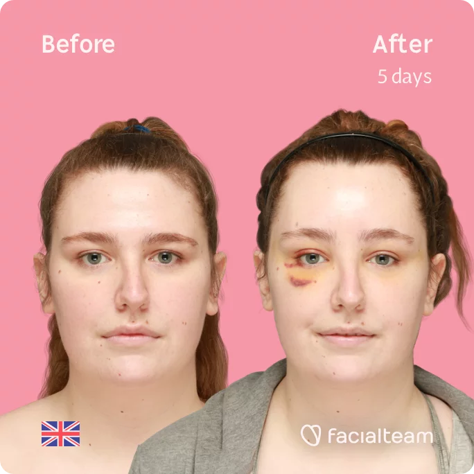 Square frontal image of FFS patient Alexis showing the results before and after facial feminization surgery with Facialteam consisting of forehead feminization surgery.