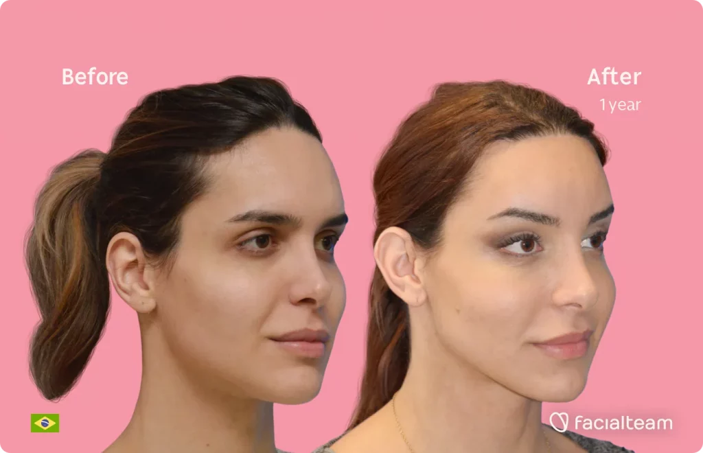 45 degree image of FFS patient Viviany showing the results before and after facial feminization surgery consisting of forehead, tracheal shave, jaw and chin feminization surgery.