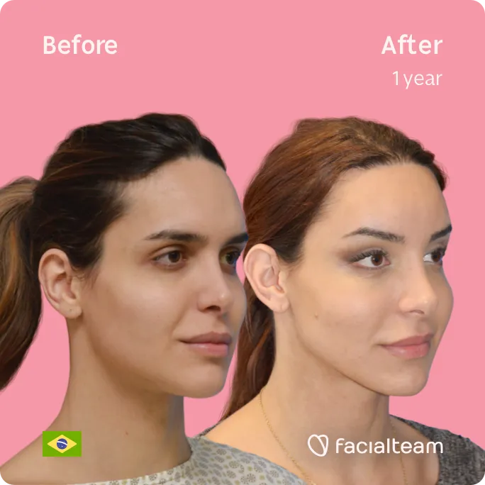 Square 45 degree image of FFS patient Viviany showing the results before and after facial feminization surgery consisting of forehead, tracheal shave, jaw and chin feminization surgery.