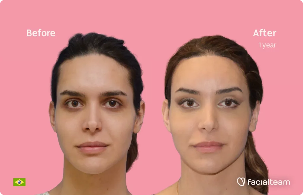 Frontal image of FFS patient Viviany showing the results before and after facial feminization surgery with Facialteam consisting of forehead, tracheal shave, jaw and chin feminization surgery.