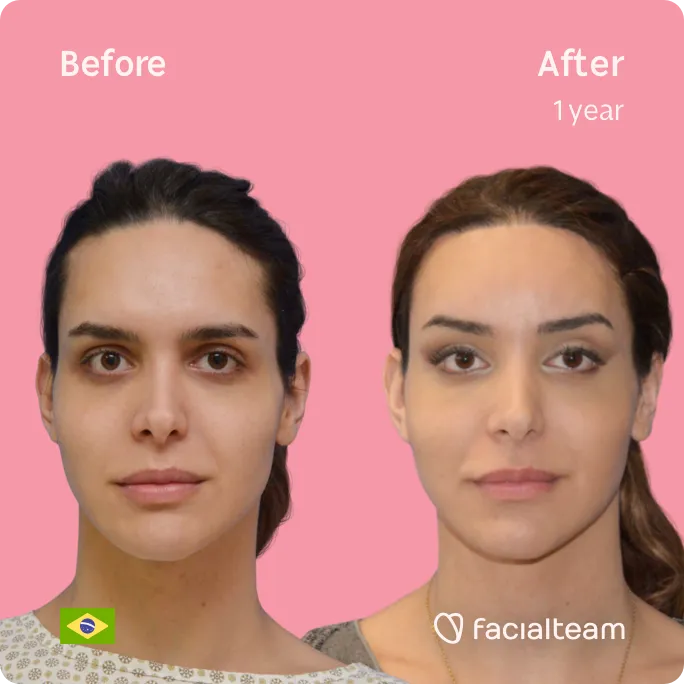 Square frontal image of FFS patient Viviany showing the results before and after facial feminization surgery with Facialteam consisting of forehead, tracheal shave, jaw and chin feminization surgery.