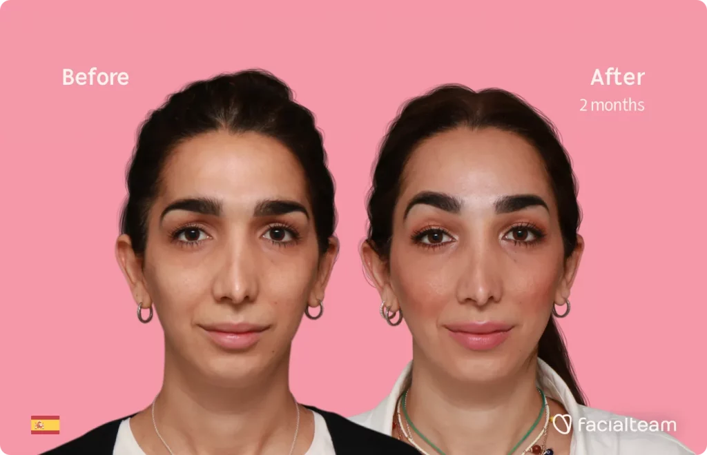 Frontal image of FFS patient Lola showing the results before and after facial feminization surgery with Facialteam consisting of forehead feminization surgery.