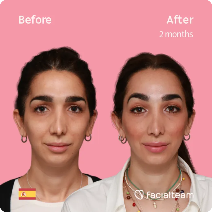Square frontal image of FFS patient Lola showing the results before and after facial feminization surgery with Facialteam consisting of forehead feminization surgery.