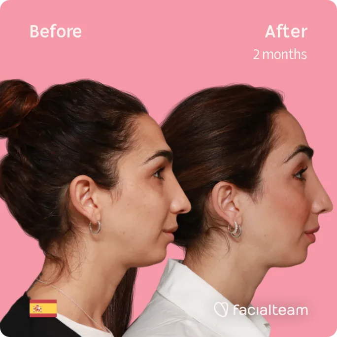 Square right side image of FFS patient Lola showing the results before and after facial feminization surgery with Facialteam consisting of forehead feminization surgery.