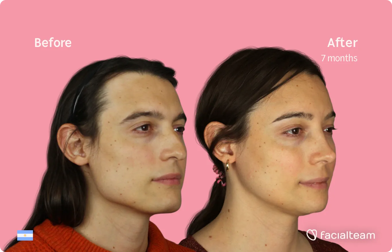 45 degree image of FFS patient Simone showing the results before and after facial feminization surgery consisting of forehead, jaw and chin, rhinoplasty feminization surgery.