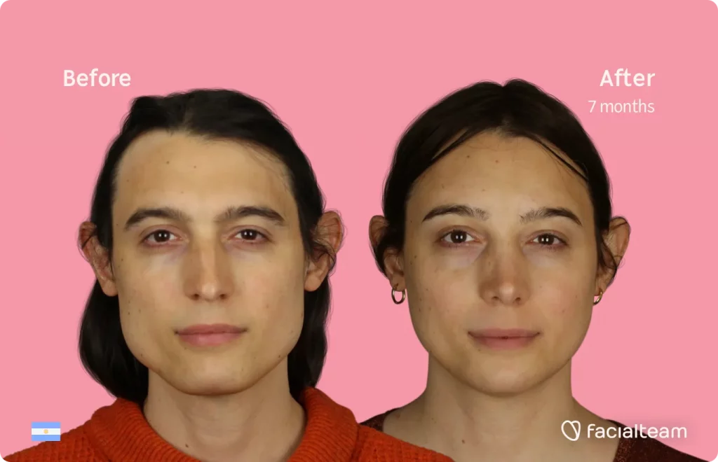 Frontal image of FFS patient Simone showing the results before and after facial feminization surgery with Facialteam consisting of forehead, jaw and chin, rhinoplasty feminization surgery.