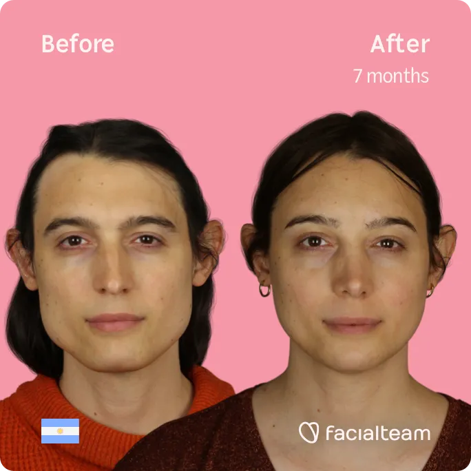 Square frontal image of FFS patient Simone showing the results before and after facial feminization surgery with Facialteam consisting of forehead, jaw and chin, rhinoplasty feminization surgery.