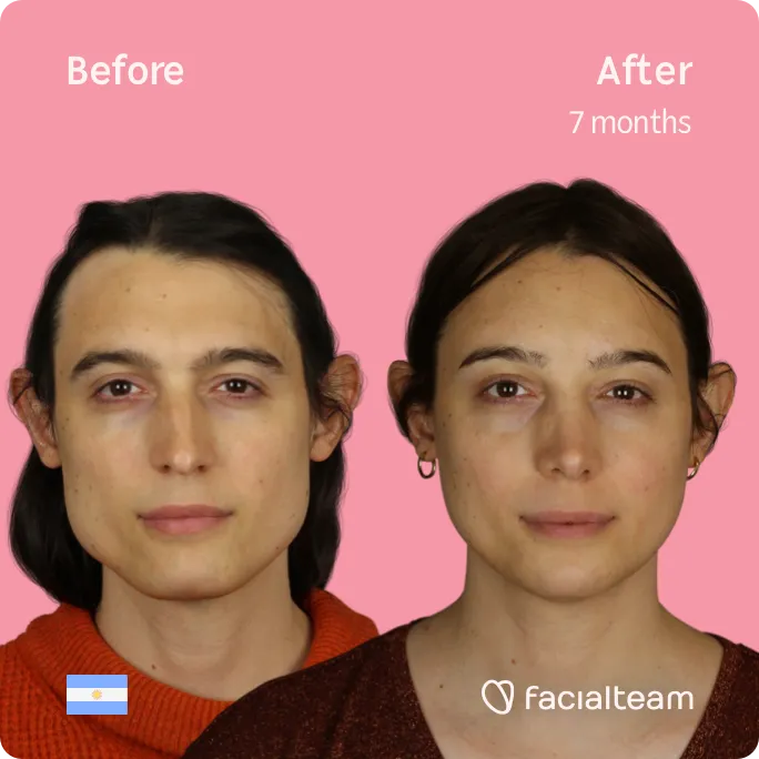 Jaw Recontouring, Angle Reduction, V-Line Face - Tes Clinic for Face and Jaw