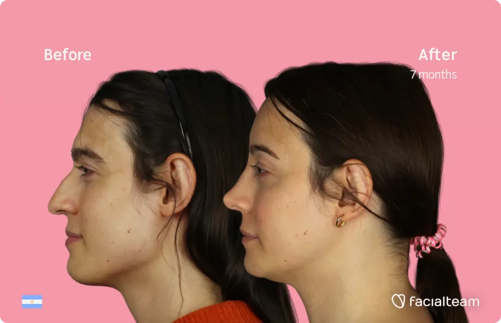 Side image of FFS patient Simone showing the results before and after facial feminization surgery with Facialteam consisting of forehead, jaw and chin, rhinoplasty feminization surgery.