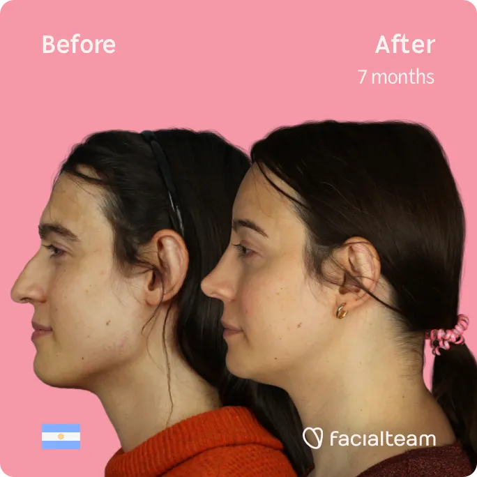 Square Side image of FFS patient Simone showing the results before and after facial feminization surgery with Facialteam consisting of forehead, jaw and chin, rhinoplasty feminization surgery.