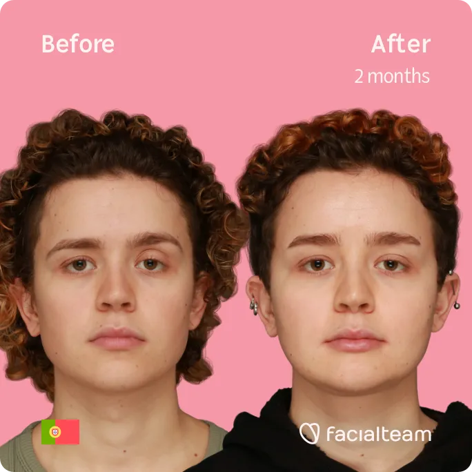 Square frontal image of FFS patient Eunice showing the results before and after facial feminization surgery with Facialteam consisting of forehead, jaw and chin, tracheal shave feminization surgery.
