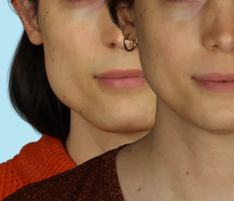 A masculine jawline before undergoing jaw feminization surgery and the result of a more feminine jawline after Jaw FFS Surgery.