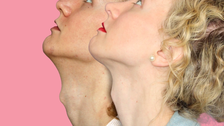 Before and after comparison of a reduced adam's apple after an Adam's Apple Reduction surgery. As a result of this surgery the adam's apple has a reduced size and gives a more feminine appearance to the neck area.