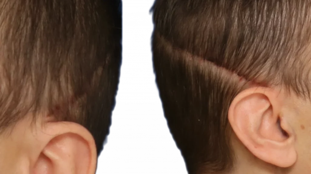 Hidden scar behind the hairline after forehead reduction surgery using the coronal approach, 1 week after surgery.