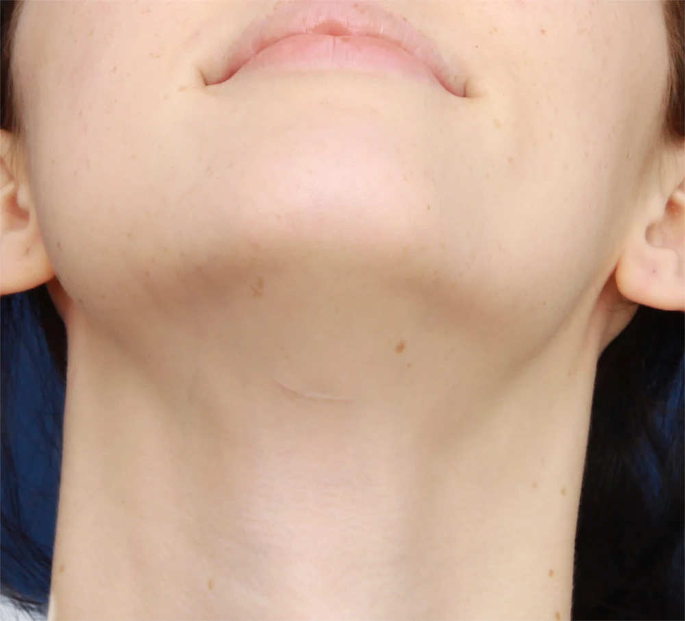 Detail of a scar after tracheal shave hidden under the chin