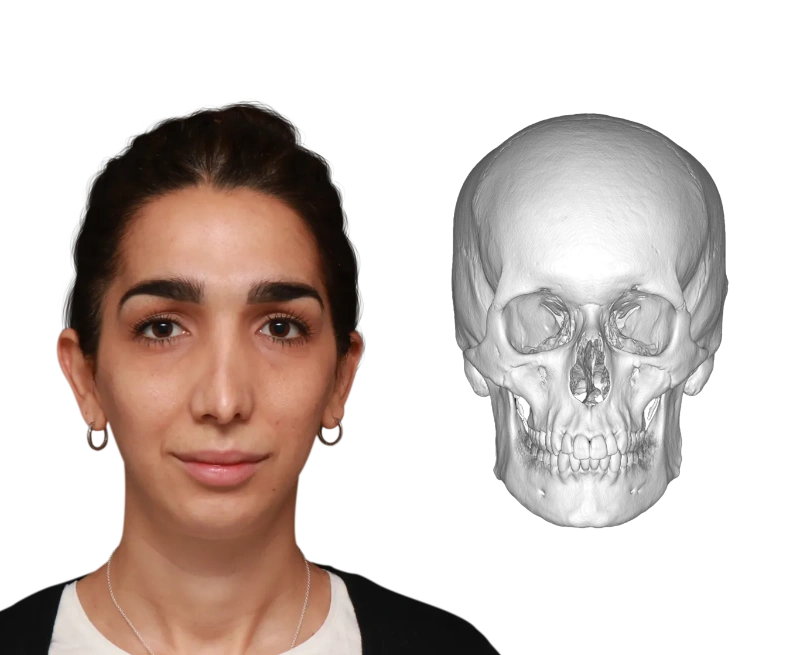 Comparison before and after forehead feminization surgery showing the results both on the exterior as on the bone level before surgery from the front.