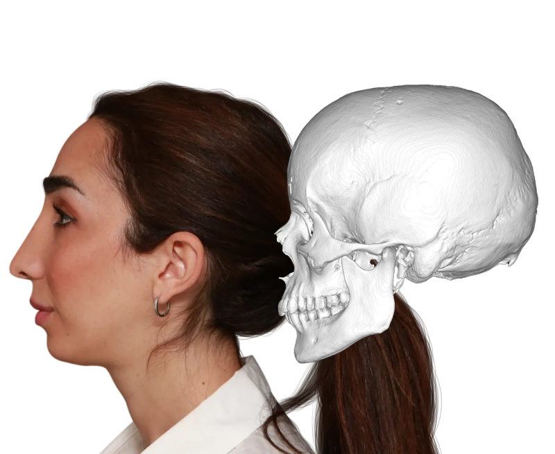 Comparison before and after forehead feminization surgery showing the results both on the exterior as on the bone level after surgery from the side.